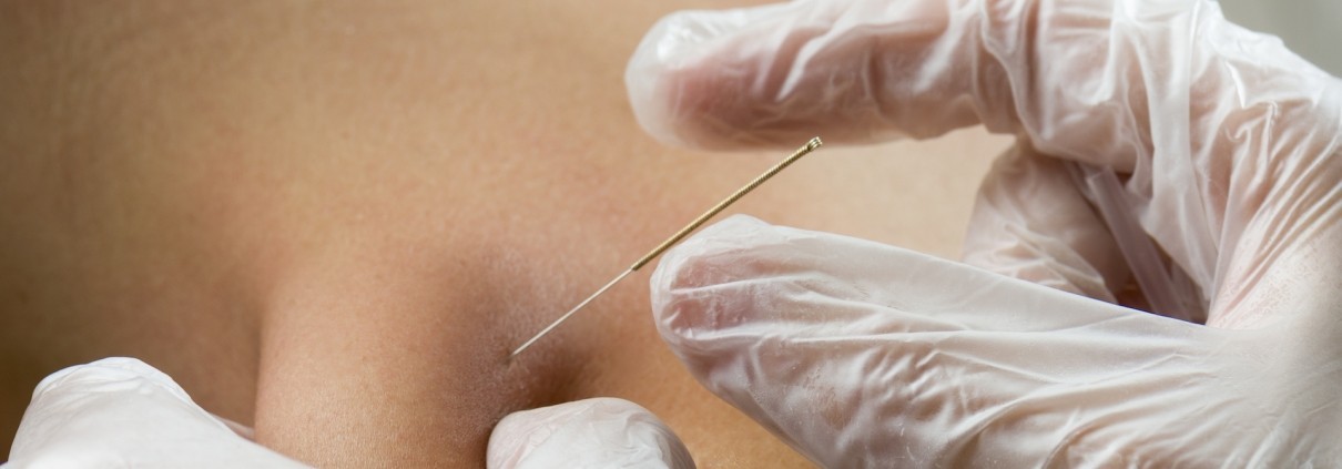 Dry Needling