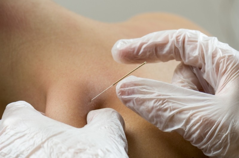 Dry needling bij Fysiopark Uden