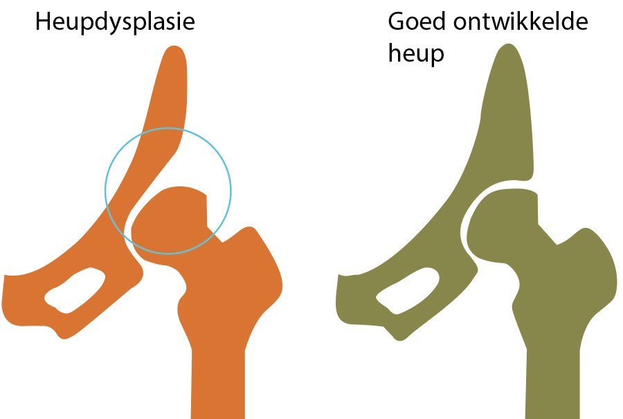 heupgewricht foto van heupdysplasie